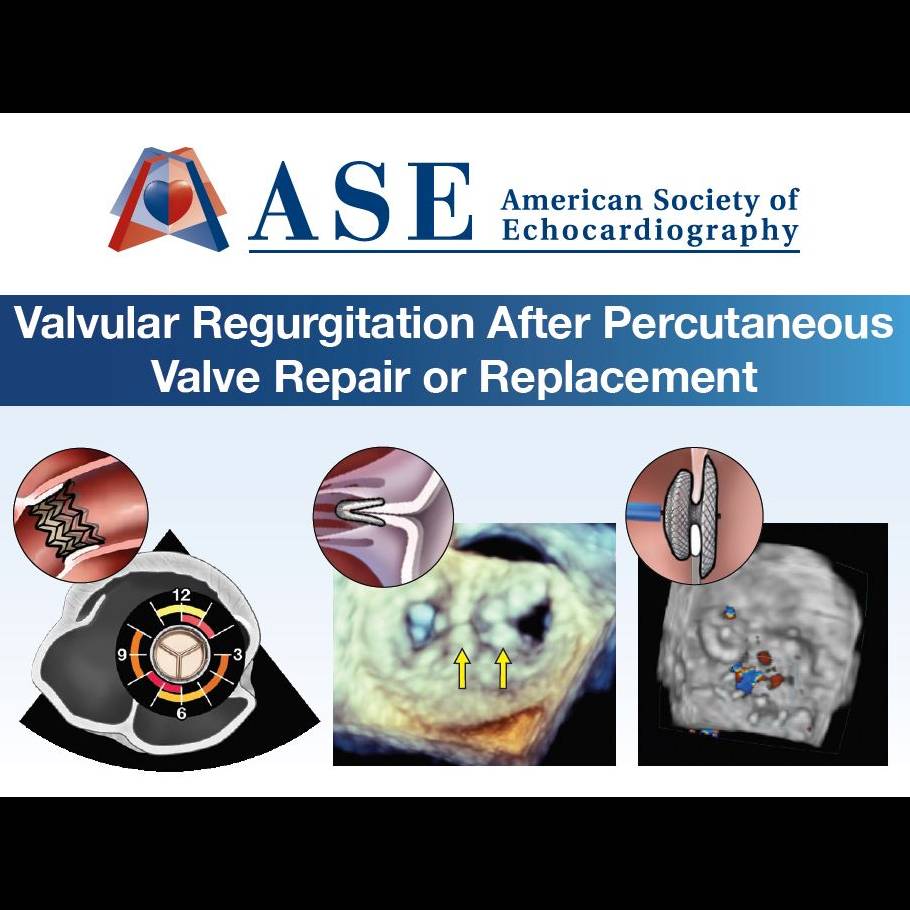 Residual Valvular Regurgitation After Percutaneous Valve Repair or Replacement Pocket Guide